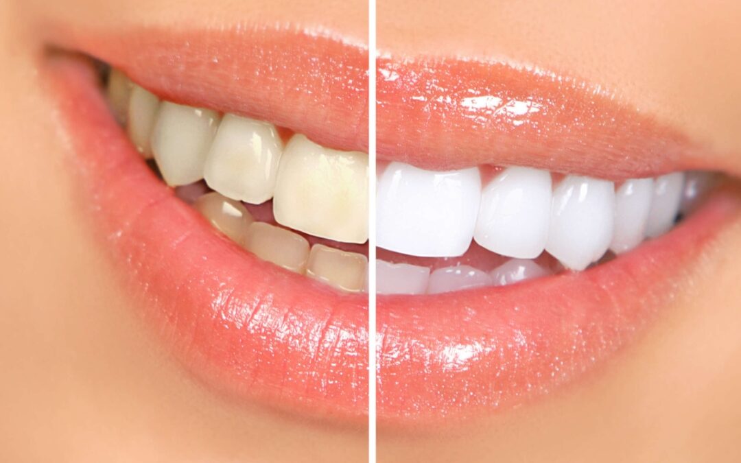 How Professional Teeth Whitening in Gilbert Transforms Smiles