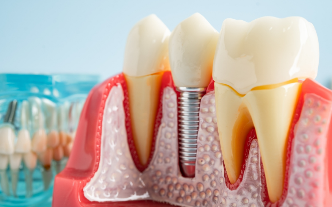 dental implants gilbert