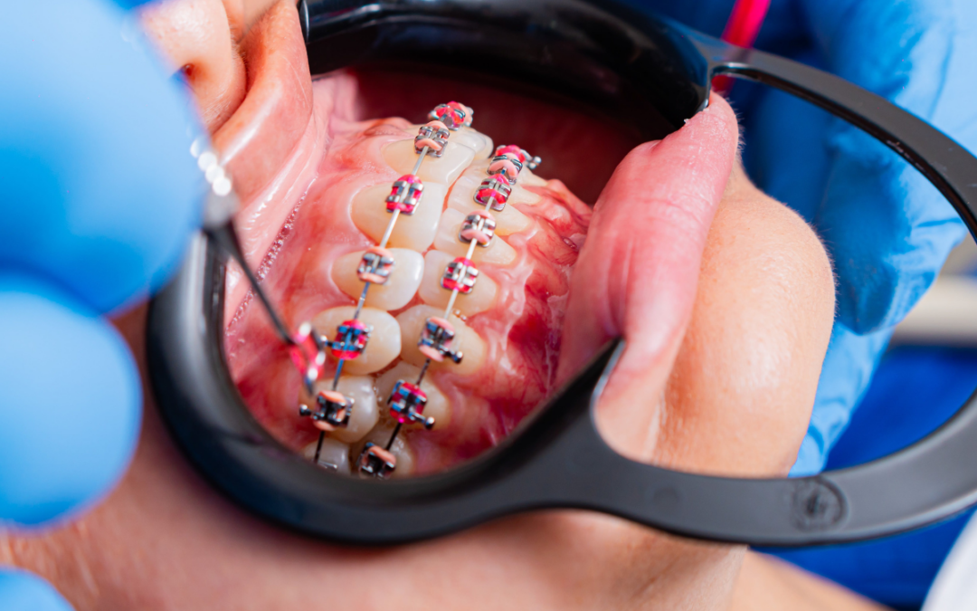 Straighten Your Smile with Confidence: A Guide to Advanced Orthodontic Care in Gilbert