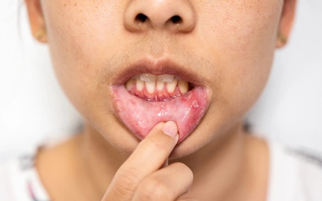What Causes Bleeding Gums and How Can You Stop Them