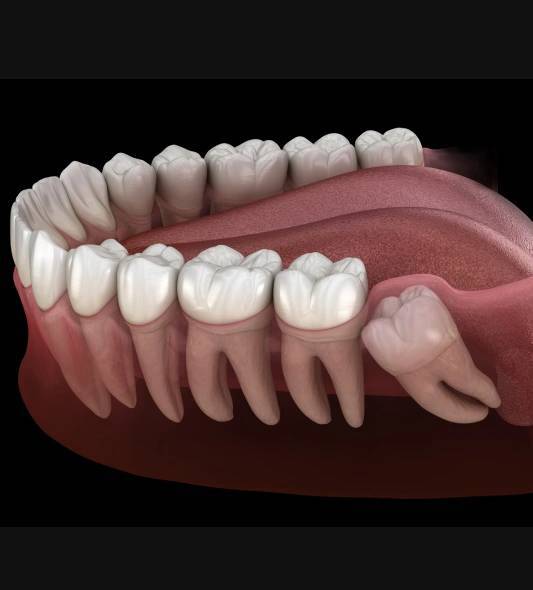 Wisdom Teeth and Headaches: Causes, Relief, and Next Steps